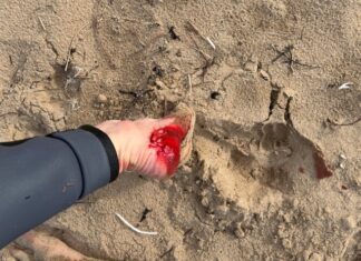 Teen bitten by shark at Middleton